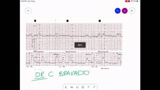 CARDIOTOCOGRAPHY  CTG INTERPRETATION [upl. by Patman]