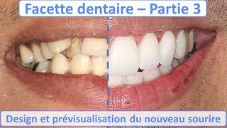 Facette dentaire  Design et Prévisualisation nouveau sourire  Guide complet  partie 3 [upl. by Arrak]