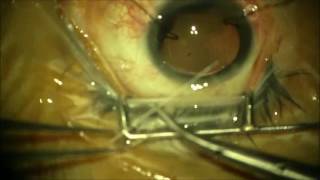 Management of traumatic cataract with 180 degree zonular dialysis and traumatic mydriasis [upl. by Diraf480]