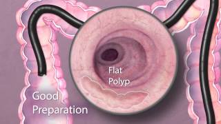 The Importance of Good Bowel Preparation During Colonoscopy [upl. by Dave]