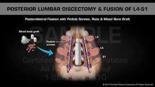 L4 L5  L5 S1 disc herniation recovered pain free without surgery [upl. by Ayle276]