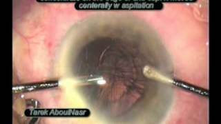 zonular dialysis  dehiscnece during phaco [upl. by Stilwell]