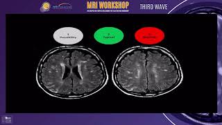 Supratentorial MS lesions  ESNPN Worshop Arabic [upl. by Crowley853]