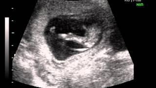 12 Weeks Pregnant Gender Determination Ultrasound [upl. by Anneis575]