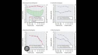 Audiogram Interpretation [upl. by Lewison]