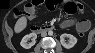 Gallstone ileus [upl. by Lekim]