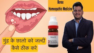 How to Use Borax Homeopathic Medicine for Mouth Ulcer  मुंह के छालों को जल्दी कैसे ठीक करें [upl. by Aitnom]