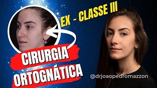 Depoimento  Cirurgia Ortognática  Classe III  Dr João Pedro Paulino Mazzon [upl. by Eceirahs191]