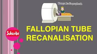 Fallopian Tube Recanalisation  Radiology Procedure  Radiographer [upl. by Gerstein379]