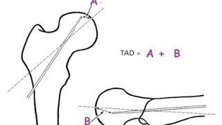 Trochanteric Fractures Complications and Salvage [upl. by Chloras]