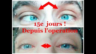 Operation du StrabismeResultat 15 jours apres Une vie normal mattend enfin strabismus operation [upl. by Kiley]