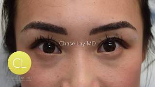 ChaseLayMD Asian Eyelid Surgery Anchoring Technique 02 [upl. by Thisbe]