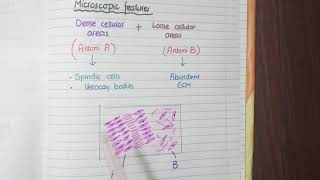 Schwannoma Pathology [upl. by Brennan]