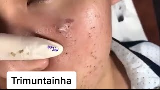 Deep Pop Blackheads On Cheek  Relax Acne Treatment Every Day [upl. by Cross]