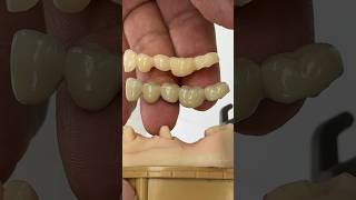 From Temp to Final EnvisiontecMain envisiontec lsk121shorts teeth dental [upl. by Anilam]