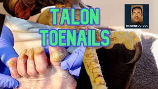 Podiatrists Cuts Toenails So Long They Look Like TALONS [upl. by Ernald462]