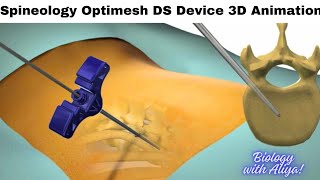 Spineology Optimesh DS Device  Medical 3D Animation  BiologywithAliya [upl. by Nalod828]