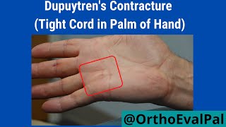 Dupuytrens Contracture Tight Cord in Palm of Hand [upl. by Gilboa]