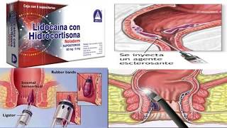 Como acabar con las hemorroides externas [upl. by Rawden]