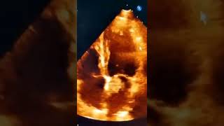 Whats your differential diagnosis 🤔MedicalMystery echocardiogram echocardiography heart echo [upl. by Ayardna]