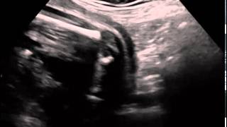 Ultrasound in Obstetrics amp Gynecology A Practical Approach  Clip 32 [upl. by Adara262]