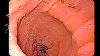 Gastric Contractionswmv [upl. by Dranyl]