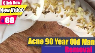 Acne 90 Year old man many blackheads  Acne Treatment 89 [upl. by Schoof137]