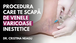 SCLEROTERAPIA – procedura care te scapă de venele varicoase inestetice  Dr Cristina Neagu [upl. by Aggappera]