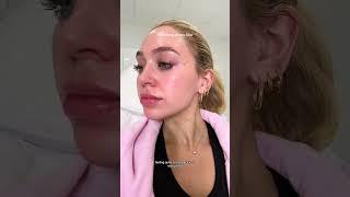 Dissolving my Lip Filler 💗 vlog lipfiller [upl. by Casabonne504]