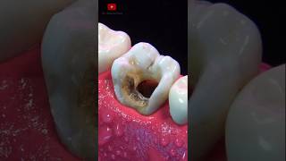 ASOMBROSA restauración dental asmr [upl. by Peggy]