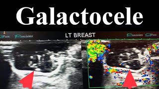 Galactocele  Lactocele  Benign Breast Lesion [upl. by Merari]