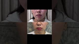 Masseter Botox drshikhabaghi timelessaesthetics botox [upl. by Rebak821]