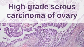 Ultrasound Video showing Ovarian cystadenomas bilateral [upl. by Sixel]