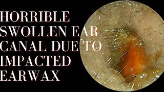 HORRIBLE Swollen Ear Canal Due To Impacted Earwax [upl. by Sukramaj]