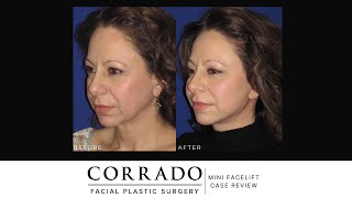 Mini Facelift Before and After Pictures  Dr Anthony Corrado [upl. by Brick855]