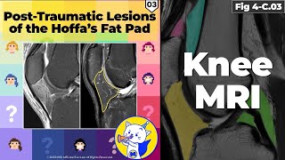 Fig 4C03 Posttraumatic Lesions of Hoffa’s Fat Pad [upl. by Aihtnys693]