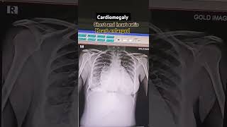 Cardiomegaly xray findings Cardiomegaly Heart Enlarged xray chestheartchestxray [upl. by Aamsa77]