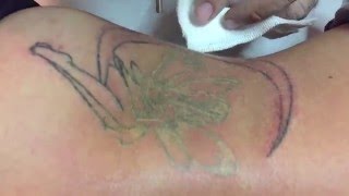 RIMOZIONE TATUAGGI CON Laser Qswtiched REVLITE  Dott Tambasco [upl. by Katherin]