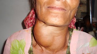 11 Goiter Treatment Without Surgery Causes and Symptoms [upl. by Adabel]