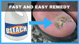 How to Get Rid of Toenail Fungus with Bleach  Toe Fungus Journey [upl. by Gniliem]