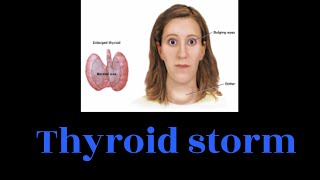 Thyroid storm  Hyperthyroidism [upl. by Kilam]