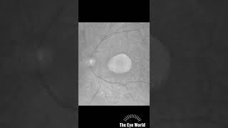 Best vitelliform macular dystrophy [upl. by Spalla]