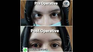 Esotropia squint  strabismus treatment with surgery Lahore Pakistan [upl. by Avirt933]