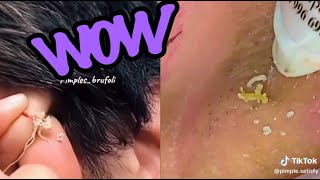 Top Satisfying Pimple Pops of 2024 Blackheads Cysts and More [upl. by Suiramad]