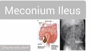 Meconium Ileus [upl. by Ahsemrac252]