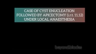 Cyst Enucleation with Apicectomy of 11 and 12 teeth under local anaesthesia [upl. by Oderf]