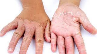 How I Use Lactic Acid 80 To Peel My Dry Hands Remove Dry Skin And Get Rid Of Hyperpigmentation [upl. by Nolaj]