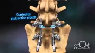 Lumbar Spondylolysthesis Correction Surgery animation [upl. by Hoebart]