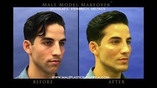 LA Male Model Makeover with Facial Filler by Dr Steinbrech 7 [upl. by Sokil]