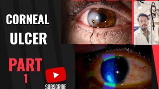 Corneal ulcer Types Causes and treatment wateringeye epiphora lacrimation doctorSight [upl. by Rotceh]